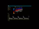 Cypress System PLUS - Vascular - Normal Common Carotid Artery (CCA) - PW Doppler