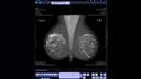 syngo.Breast Care Reading
