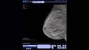 syngo.Breast Care Tomo