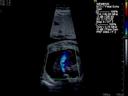 Hypoplastic Left Fetal Heart with Pleural Effusion