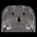 CT Scanner SOMATOM Scope