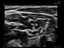 ACUSON Freestyle Series ultrasound systems for Anesthesiology
