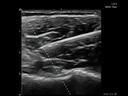 ACUSON Freestyle Series ultrasound systems for MSK