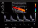 ACUSON X700 Ultrasound System – Common Carotid Artery (CCA) Plaque - Color and PW Doppler