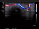 ACUSON X700 Ultrasound System - Digital Artery – Color Doppler