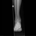 Mobilett Mira Max Ankle a.p.