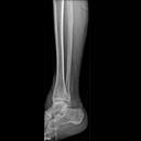 Mobilett Mira Max Ankle lat Image