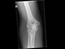 Mobilett Mira Max Elbow a.p. Image