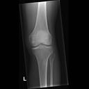 Mobilett Mira Max Knee a.p. Image