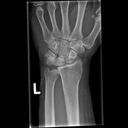 Mobilett Mira Max Wrist d.v. Image
