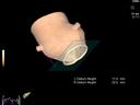 Aortic Valve