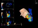Aortic Valve with Color
