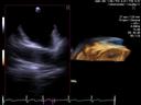 ACUSON AcuNav V ultrasound catheter