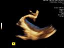 ACUSON AcuNav V ultrasound catheter