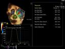 Mitral and Aortic Valve