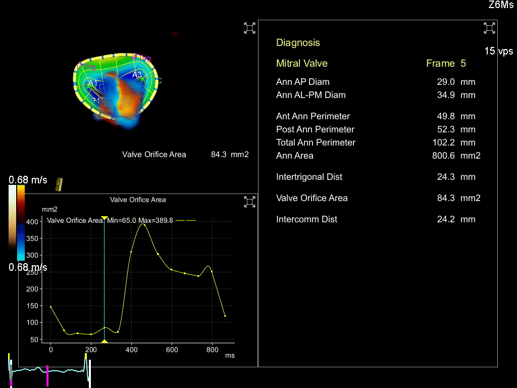 Mitral Valve