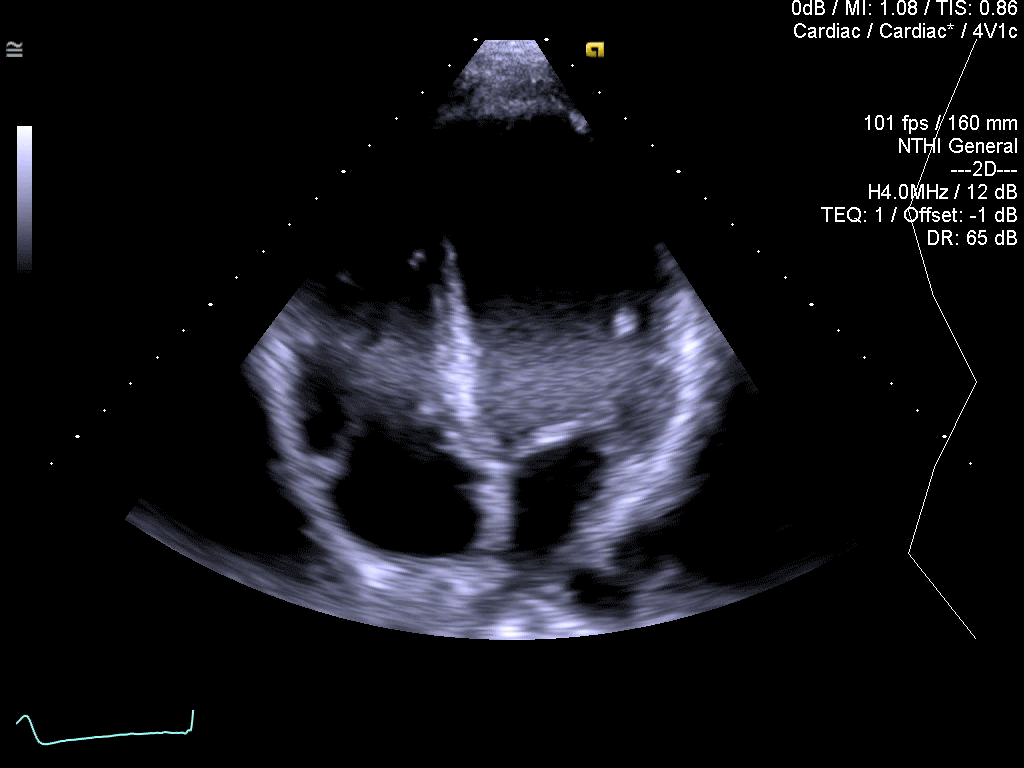TEQ™ ultrasound technology