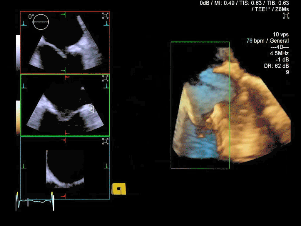 3D TEE of Mitral Valve