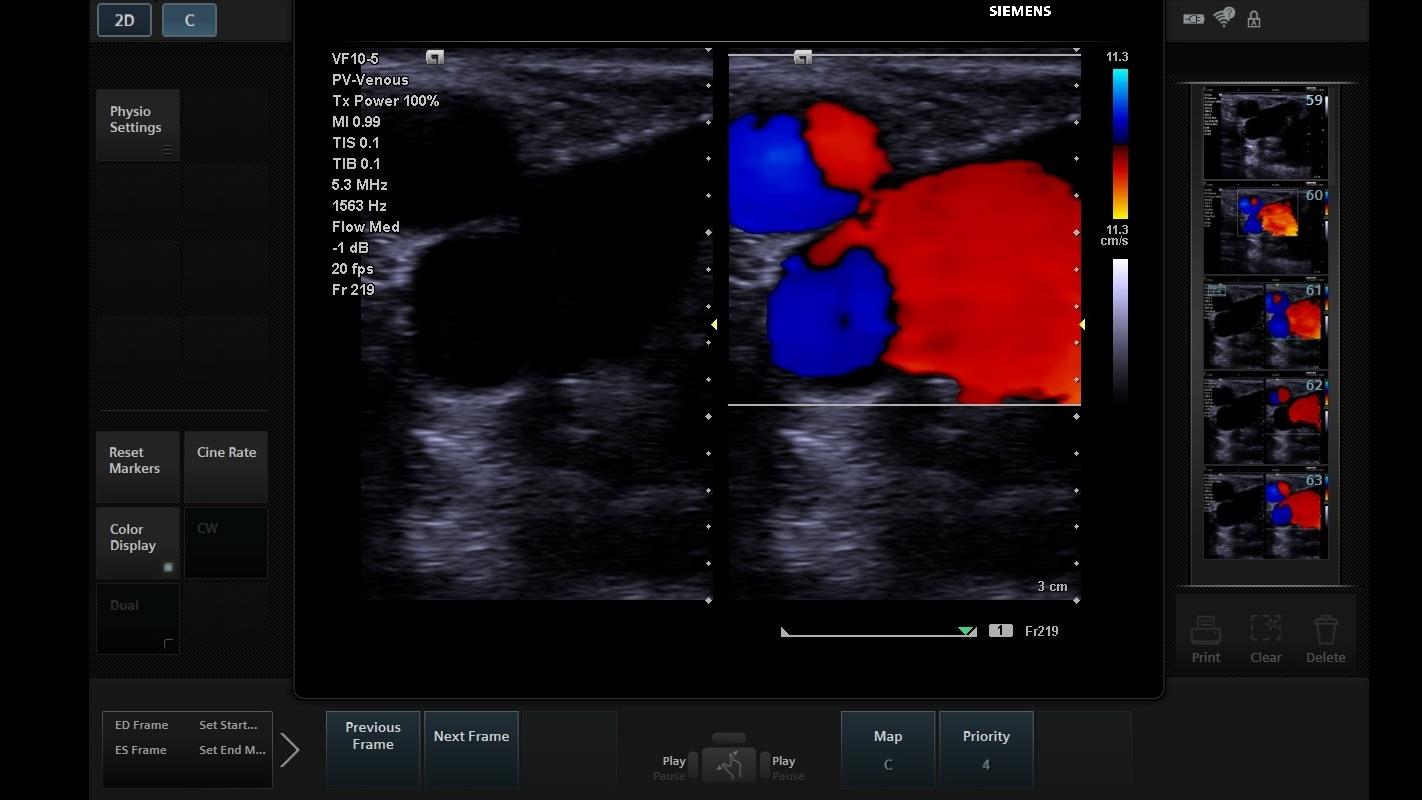 ACUSON P500 Ultrasound System