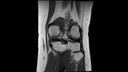 PD TSE, Coronal, voxel 0.5 x 0.5 x 3.0 mm, TA 3:14 min