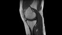 PD TSE, Sagittal, voxel 0.5 x 0.5 x 3.0 mm, TA 3:12 min