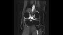 T2 FS TSE, Coronal, voxel 0.6 x 0.6 x 3.0 mm, TA 3:08 min
