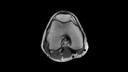 PD TSE, Axial, voxel 0.4 x 0.4 x 3.0 mm, TA 3:26 min