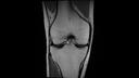 PD TSE, Coronal, voxel 0.4 x 0.4 x 3.0 mm, TA 3:14 min