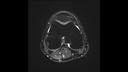 T2 FS TSE, Axial, voxel 0.4 x 0.4 x 3.0 mm, TA 3:11 min