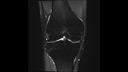 T2 FS TSE, Coronal, voxel 0.4 x 0.4 x 3.0 mm, TA 2:57 min