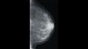 A mammography image acquired with the Mammomat.