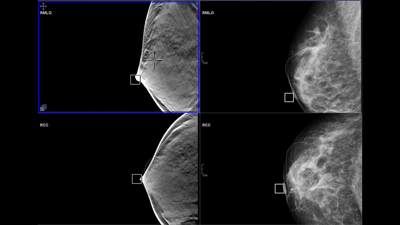 How can tomo reading be further optimized?