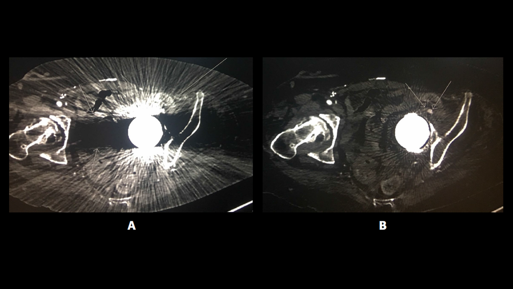 Prosthetic Metallic Artifact Reduction