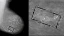 Early digital mammogram with CAD