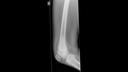 Bone tumor