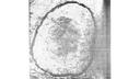 Early Xeroradiograph
