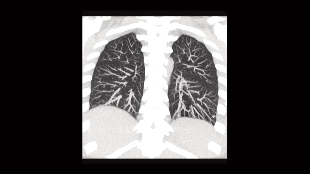 How Long To Live With Stage 4 Throat Cancer