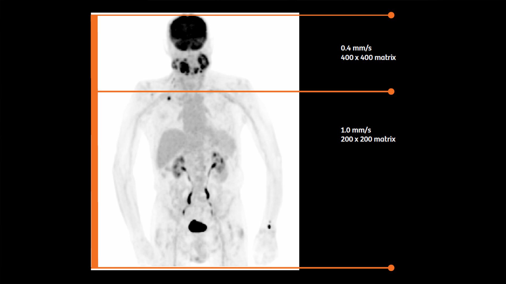 PET/CT reveals recurrent disease in patients with head and neck cancers