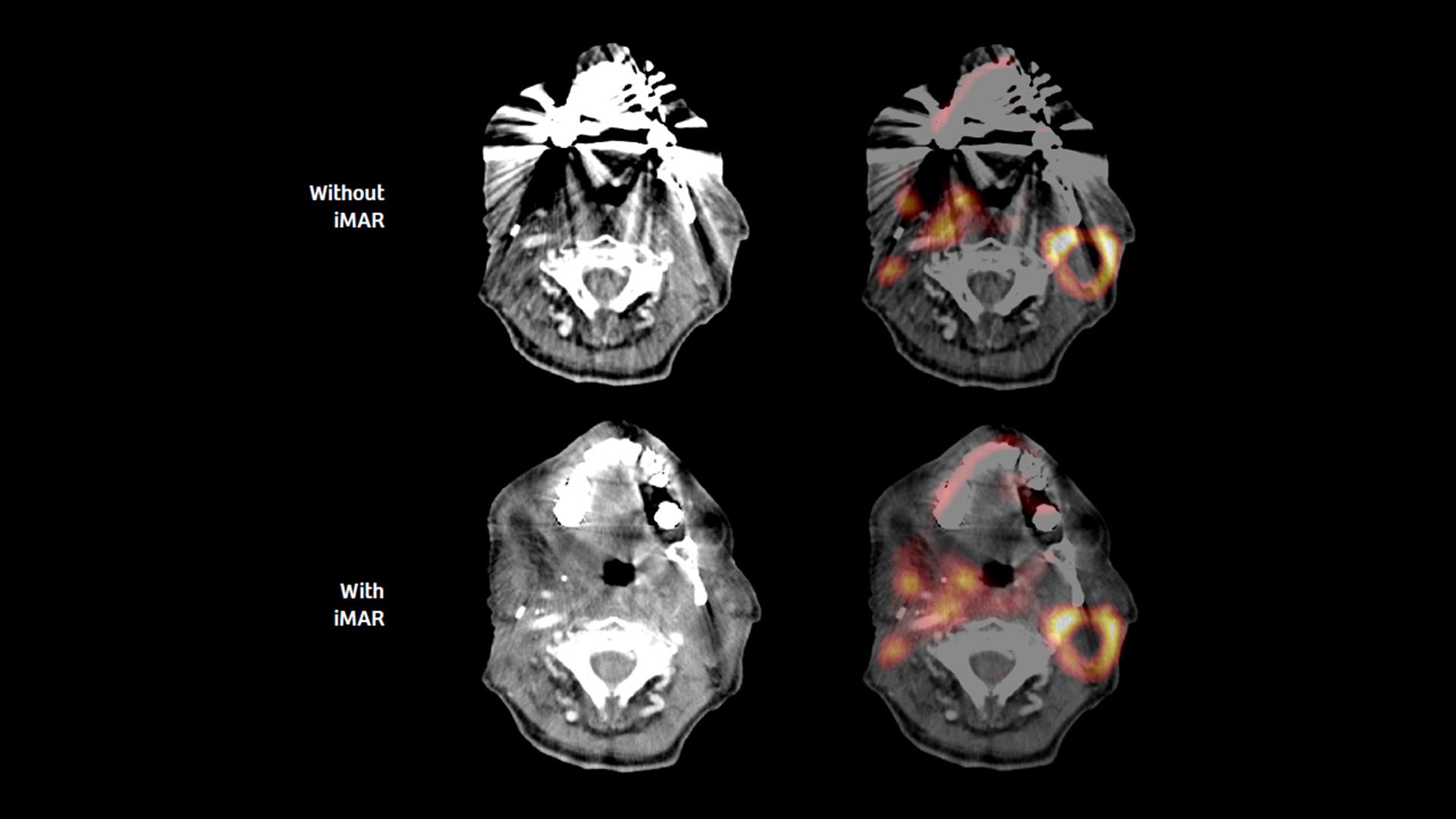 PET/CT reveals recurrent disease in patients with head and neck cancers