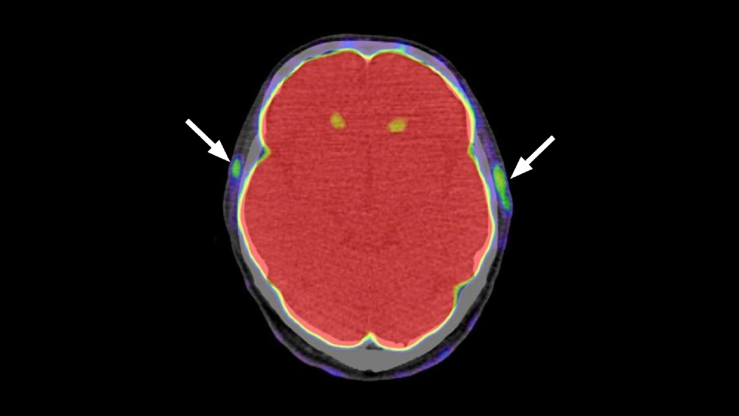 PET/CT Detection Of Temporal Arteritis