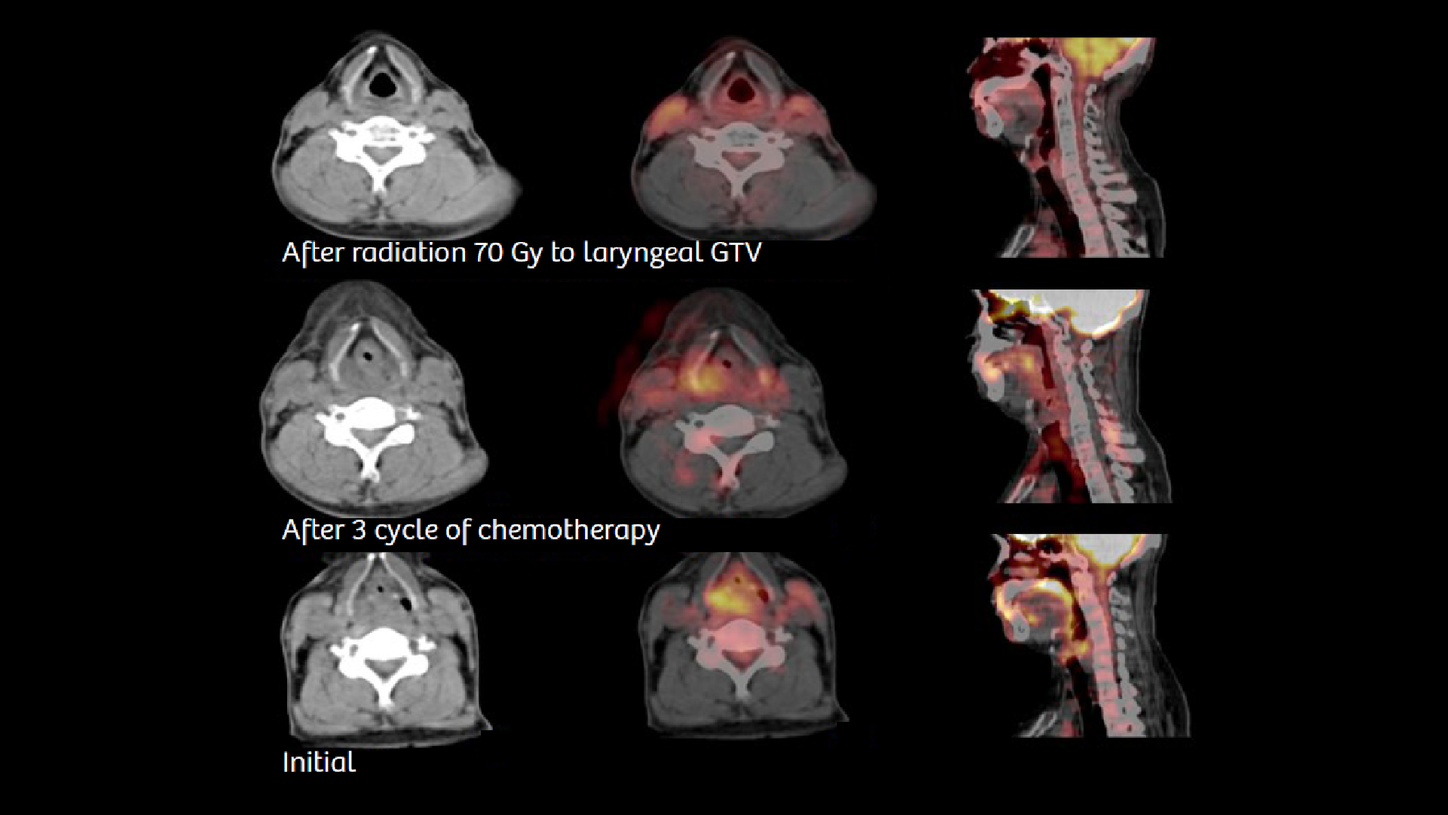Coexisting laryngeal tumor in a patient with esophageal carcinoma ...