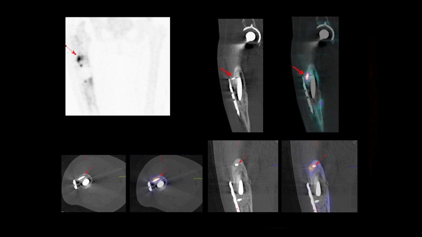 SPECT/CT delineation of proximal screw loosening and distal ...