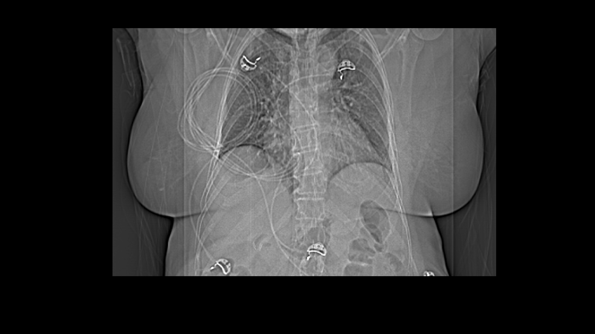 SPECT/CT breastattenuation artifact for improved specificity