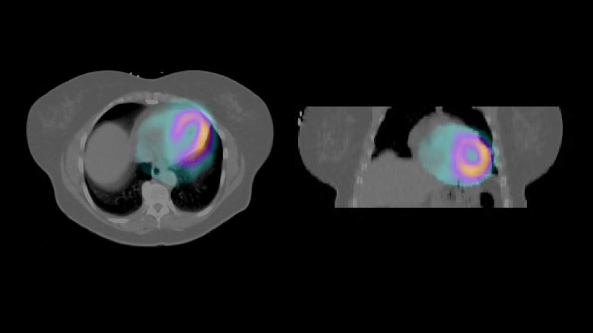 SPECT CT Overcomes Breast attenuation Artifact For Improved Specificity