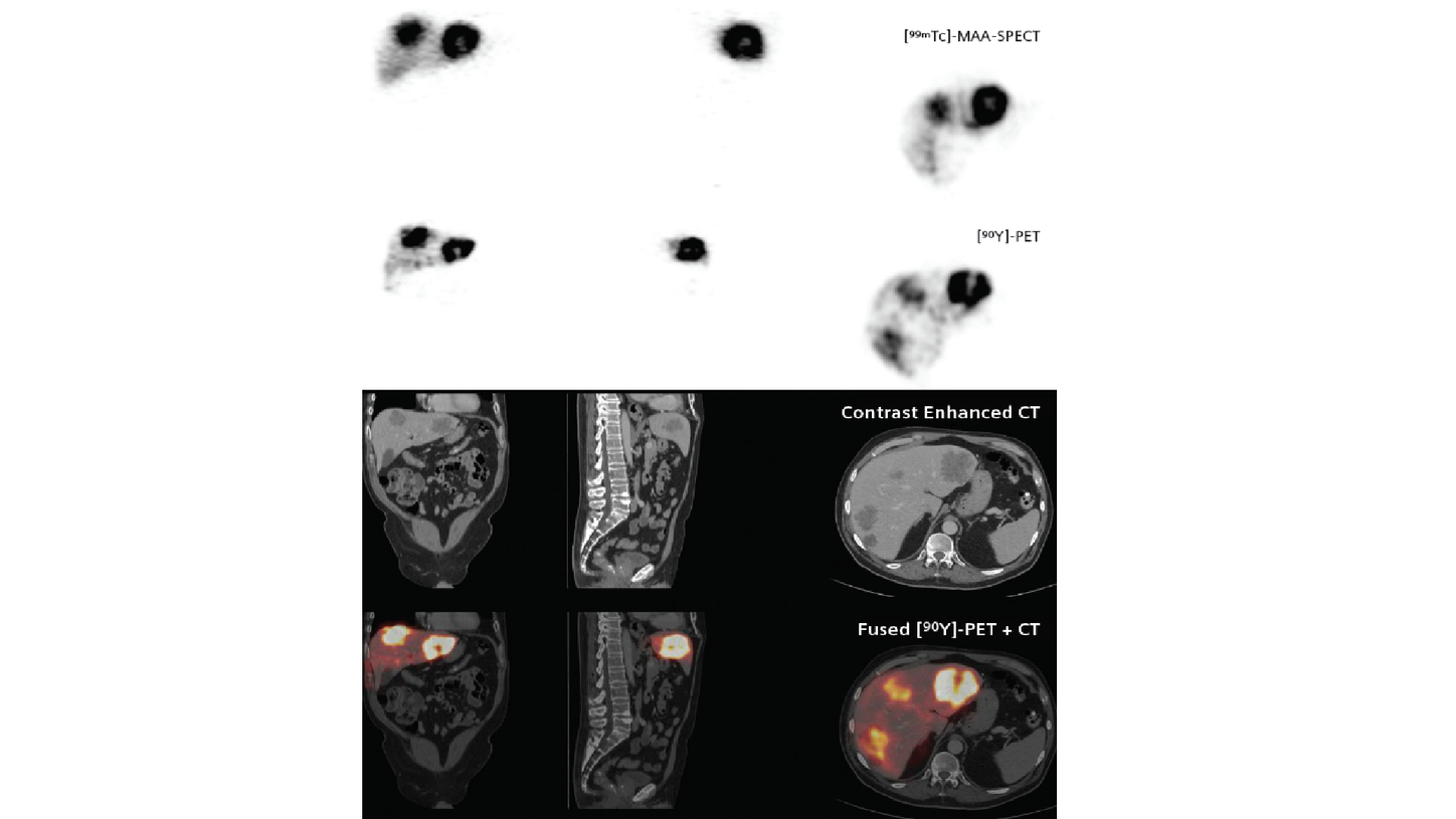 Quantitative SPECT imaging of hepato-pulmonary shunting prior to SIR ...