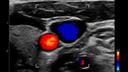 ACUSON Freestyle Series ultrasound systems for Interventional Radiology