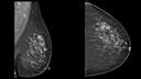Tomosynthesis could help increase cancer detection.