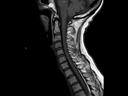 Sagittal T1 tse-MAGNETOM Altea