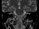 Coronal T2 tse-MAGNETOM Altea