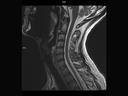 Sagittal T2 TSE-MAGNETOM Vida